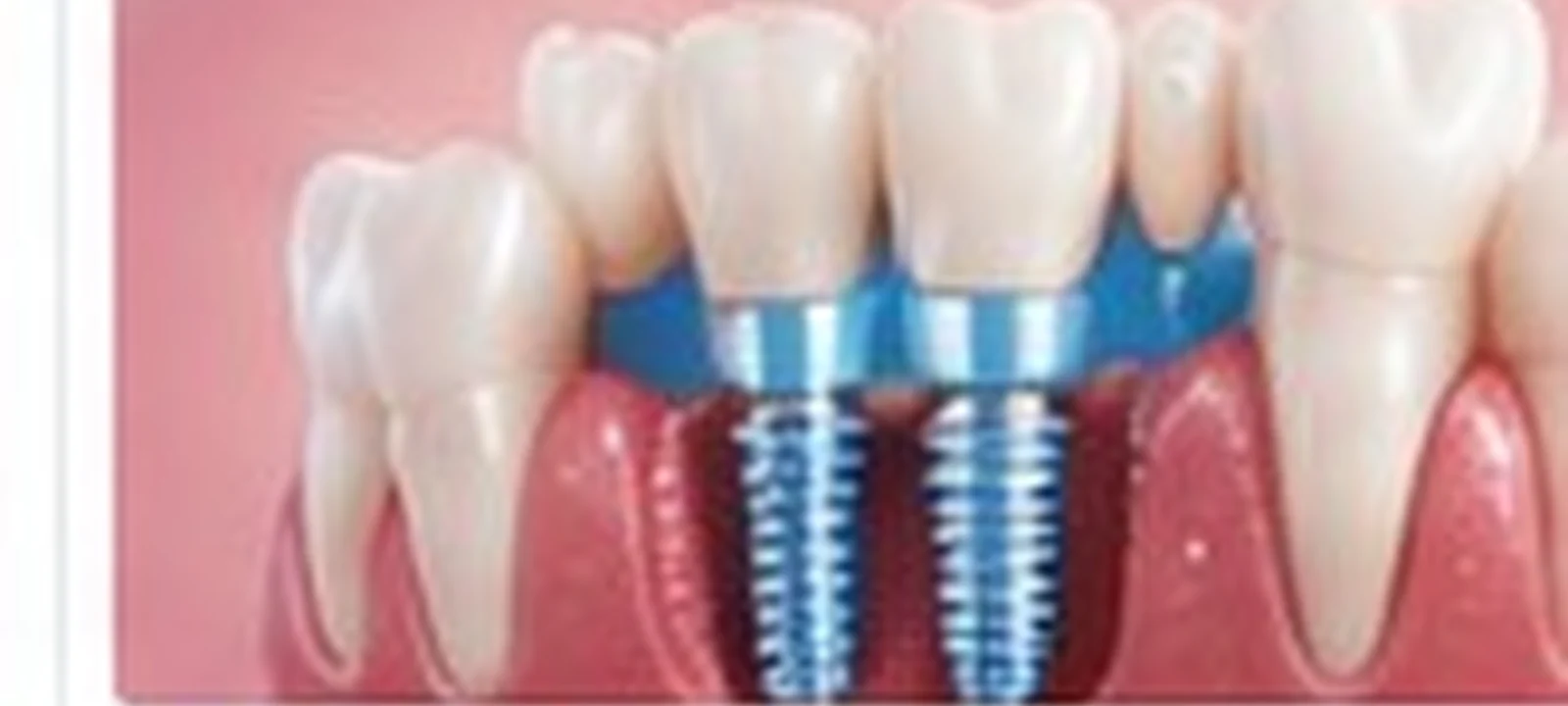 All-on-4 dental implants cost in India | Hospitals of India